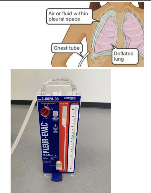 <p>Drain</p><p>Purpose: used to drain air, blood, or fluid from pleural space</p>