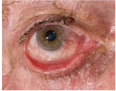 <p>unable to or abnormal closure of the lid</p><p>outward turning, sagging of eyelid margin</p>