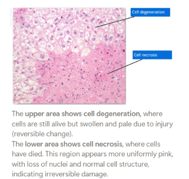 <p><strong>The cytoplasm appears pinker.</strong></p><p>When a cell is damaged, RNA breaks down, so their is less blue staining.</p><ul><li><p>RNA is basophilic, meaning it binds to haematoxylin (a blue dye).</p></li></ul><p>Additionally, as the cell dies, proteins in the cytoplasm become denatured (they lose their normal structure).</p><ul><li><p>Eosin (an acidic pink dye) binds more strongly to these altered proteins.</p><ul><li><p>This makes the cytoplasm appear pinker.</p></li></ul></li></ul><p><strong>Cells often become</strong> <span><strong>smaller</strong></span> <strong>after death</strong> </p><ul><li><p>Rather than remaining swollen.</p></li></ul><p><strong>No cell membrane.</strong></p><ul><li><p>This appears as a lack of distinct borders between adjacent cells.</p><ul><li><p>These cells thus seem to blend together (appear uniformly pink)</p></li></ul></li></ul><p><strong>Nuclear changes</strong> </p><ul><li><p><strong>Pyknosis </strong>(a shrunken, dark-staining nucleus)</p></li></ul><ul><li><p><strong>Karyorrhexis </strong>(fragmentation of the nucleus)</p></li></ul><ul><li><p><strong>Karyolysis </strong>(‘fading’ of the nucleus as it loses affinity for haematoxylin (blue staining dye))</p></li></ul><p></p>