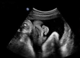 <p>What is being depicted in this image?</p><p>a. Normal nose/lips</p><p>b. Cleft lip</p><p>c. Cleft palate</p><p>d. Proboscis</p>
