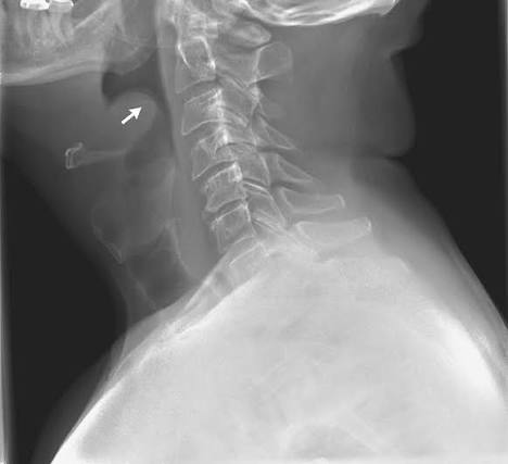 <p>CXR finding of?</p>