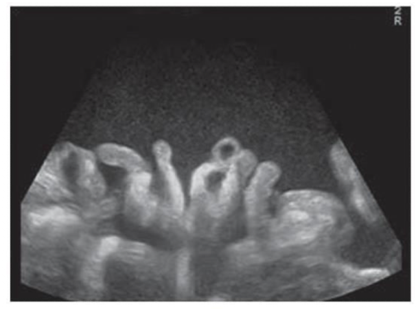 <p>What type of ascites is shown in this image?</p>