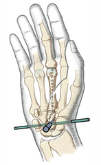 <p>No they migrate through wrist motion</p>