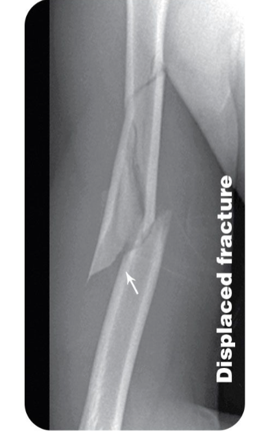 <p>broken bone pieces are out of normal alignment; into 2 of more pieces</p>