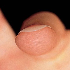 <p>what nail condition is this?</p>