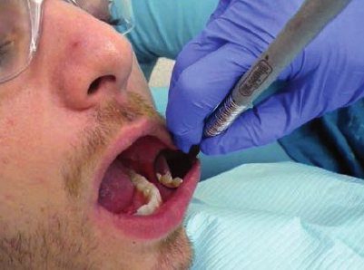 <ul><li><p>3 o’ clock position</p></li><li><p>Rest finger on left side of patient’s face</p></li><li><p>Retract buccal mucosa with mirror. Use mirror for indirect vision to view distal surfaces of the teeth</p></li></ul><p></p>