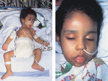 <ul><li><p>def. <strong>a-glucosidase </strong>(GAA) or <strong>acid maltase </strong> → dec. glycogen breakdown in lysosome (muscle)</p></li><li><p>symptoms: <strong>cardiomegaly, floppy <u>infant</u> syndrome </strong>(hypotonia, low CK), <strong>macroglossia, resp. issues</strong></p><ul><li><p>high CPK, AST, LDH, glycogen filled vacuoles</p></li></ul></li></ul><p></p>