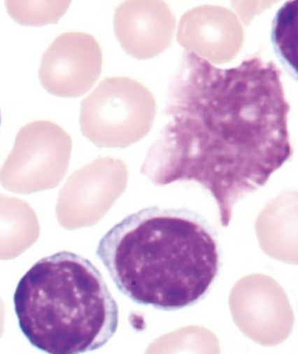 <p>Smudged nucleus with no cell membrane or granules, produced by blood smear preparation, and common in Chronic Lymphocytic Leukemia due to cell fragility</p>