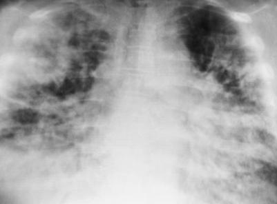 <p>Diffuse infiltrate; air space consolidation obscures heart border. Viral</p>