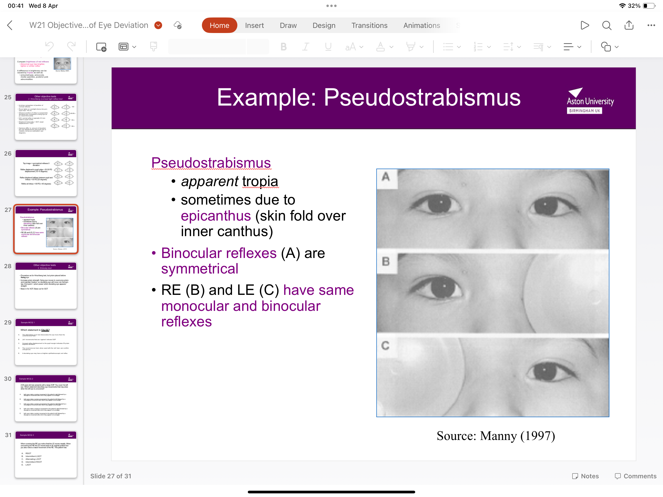 <p>Apparent tropia- binocular reflexes are symmetrical as RE and LE have the same monocular and binocular reflexes </p>