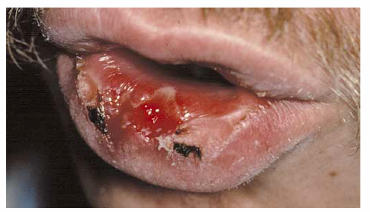 <p>1.what is this lesion?</p><p>2. how to treat/ manage it?</p><p>3. classification of oral lesion in HIV?</p>