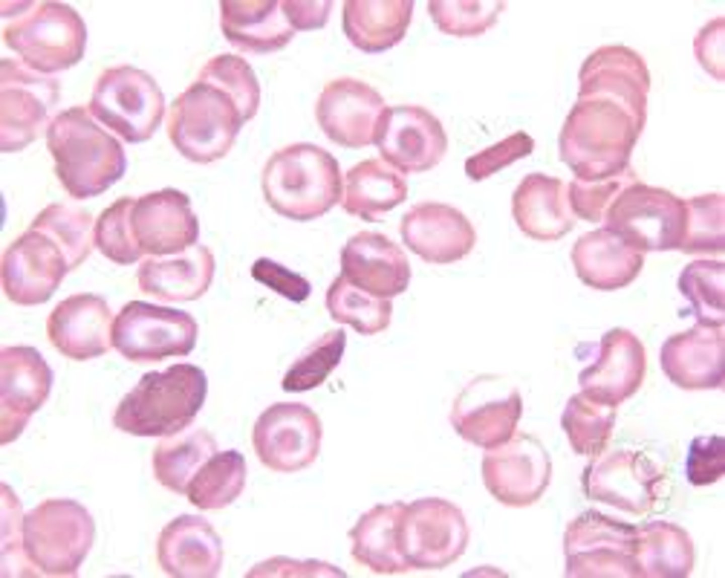 <p>Hemoglobin C disease</p>