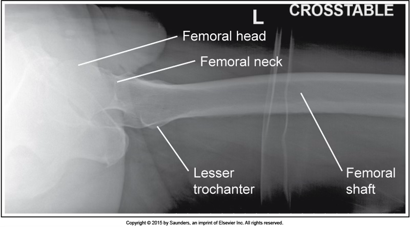 <p>lateral femur</p>