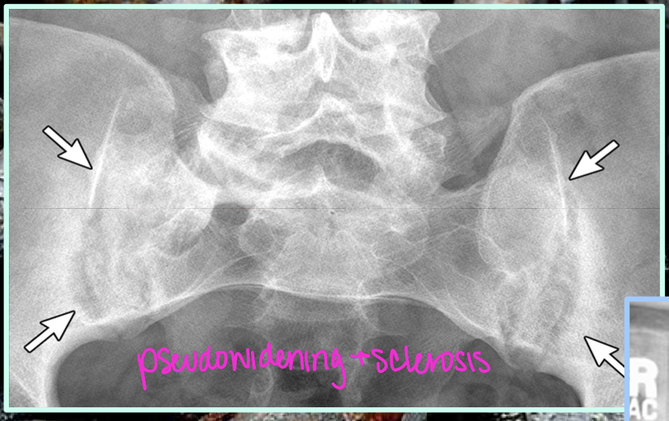 <p>We can see JSN and subchondral sclerosis in OA, which feature of AS is not seen in OA</p>