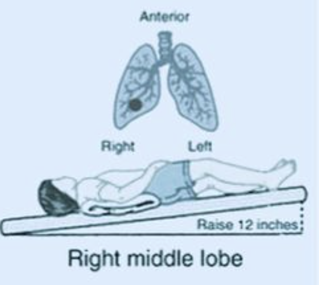 <p>- Position the patient one quarter turn from supine with the foot of the bed elevated 12 inches</p><p>- Area to percuss is just above the right nipple and under the armpit</p>