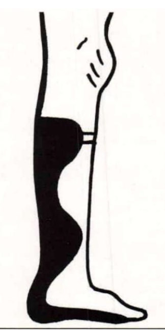 <p>Sabolich Flange Modification</p>