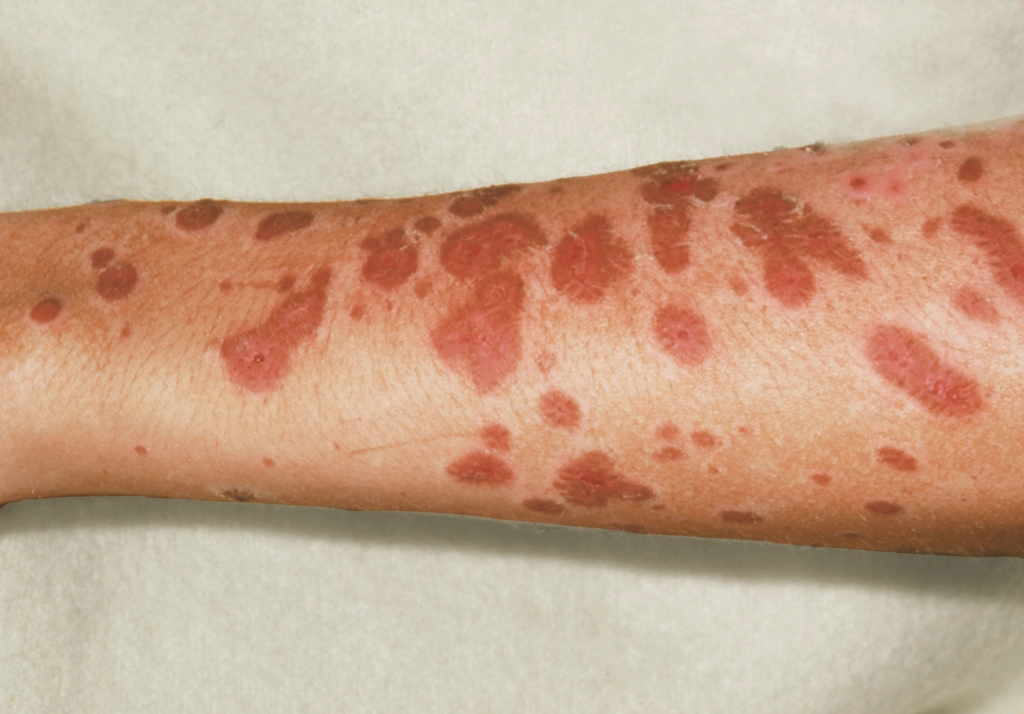 <p>Stevens-Johnson Syndrome</p>
