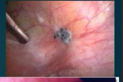<p>Secondary to medical therapy, if it is ineffective or contraindicated. This can help to relieve pain in ~50% of patients. Further complications as a result of endometriosis (ruptured ovarian cyst, torsion of the fallopian tube) or severe invasive disease may necessitate surgery. Two methods: </p><ol><li><p>Conservative: Restores normal autonomy for those that may want to reproduce in the future or do not want to begin menopause. Laparoscopic approach, in order to lyse/excised/ablated characterstic gunshot/powder burn lesions. </p></li><li><p>Definitive: Bilateral oophorectomy (Just ovary removal, to induce early menopause) or the removal of the ovaries, uterus and the fallopian tubes = hysterctomy </p></li></ol><p>Despite surgeries, lesions may return and/or px symptoms may not improve.</p>