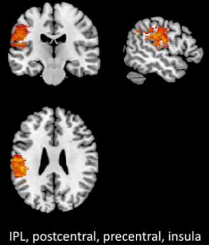 <p>Segment-level deficits</p><ul><li><p>Ghost → ‘goath’</p></li><li><p>Phoneme distortions</p></li></ul><p></p>