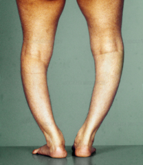 <p>lack of vitamin D</p>