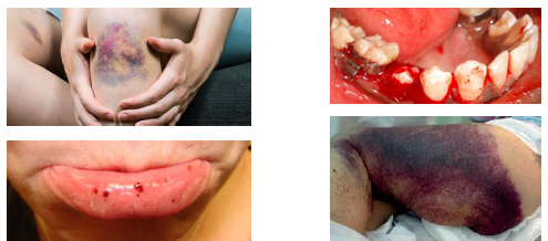 <p>•Inherited deficiency of clotting factor VIII</p><p>•Most common form of hemophilia disorder</p><p>•X linked recessive trait affects mostly males</p><p>•Carrier mothers pass gene to affected sons</p><p>•Severity depends on factor VIII levels present</p>