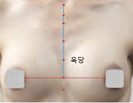 <p>앞정중선 위, 3째 갈비사이공간 높이</p>