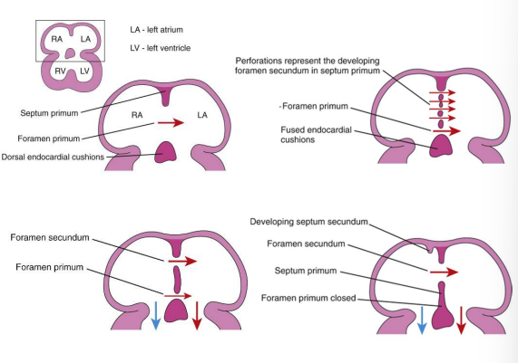 <ol><li><p>Septum primum (first septum) grows downward from the roof of the atrium toward the endocardial cushions. </p></li><li><p>An opening remains (between the septum primum &amp; endocardial cushions) called the foramen primum </p></li><li><p>Septum premium and endocardial cushions fuse forming the primordial AV septum which divides the atrioventricular canal into right and left segments. </p></li><li><p>Perforations (via apoptosis) appear in the septum primum called the foramen secundum which allows fetal venous return to the R atrium to pass across to the L atrium</p></li><li><p>Septum secundum (second septum) grows downward to the right of the septum primum overlapping the foramen secundum forming an incomplete partition called the foramen ovale </p></li><li><p>Cranial part of septum primum disappears and the remaining part of the septum, attached to the endocardial cushions, forms the valve of the foramen ovale, allowing fetal blood to pass from the R atrium to the L atrium</p></li></ol><p></p>