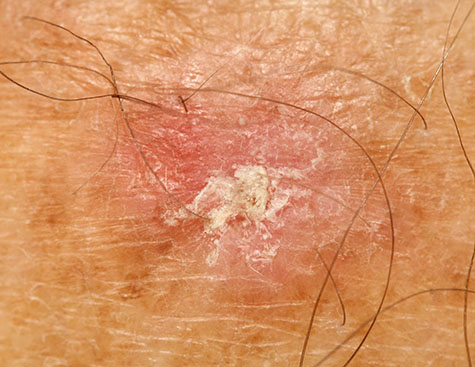 <p>What is an actinic keratosis?</p>
