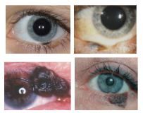 <p>What is the most likely diagnosis ?</p>