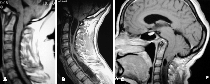 <p>CAUDAL DISPLACEMENT</p>