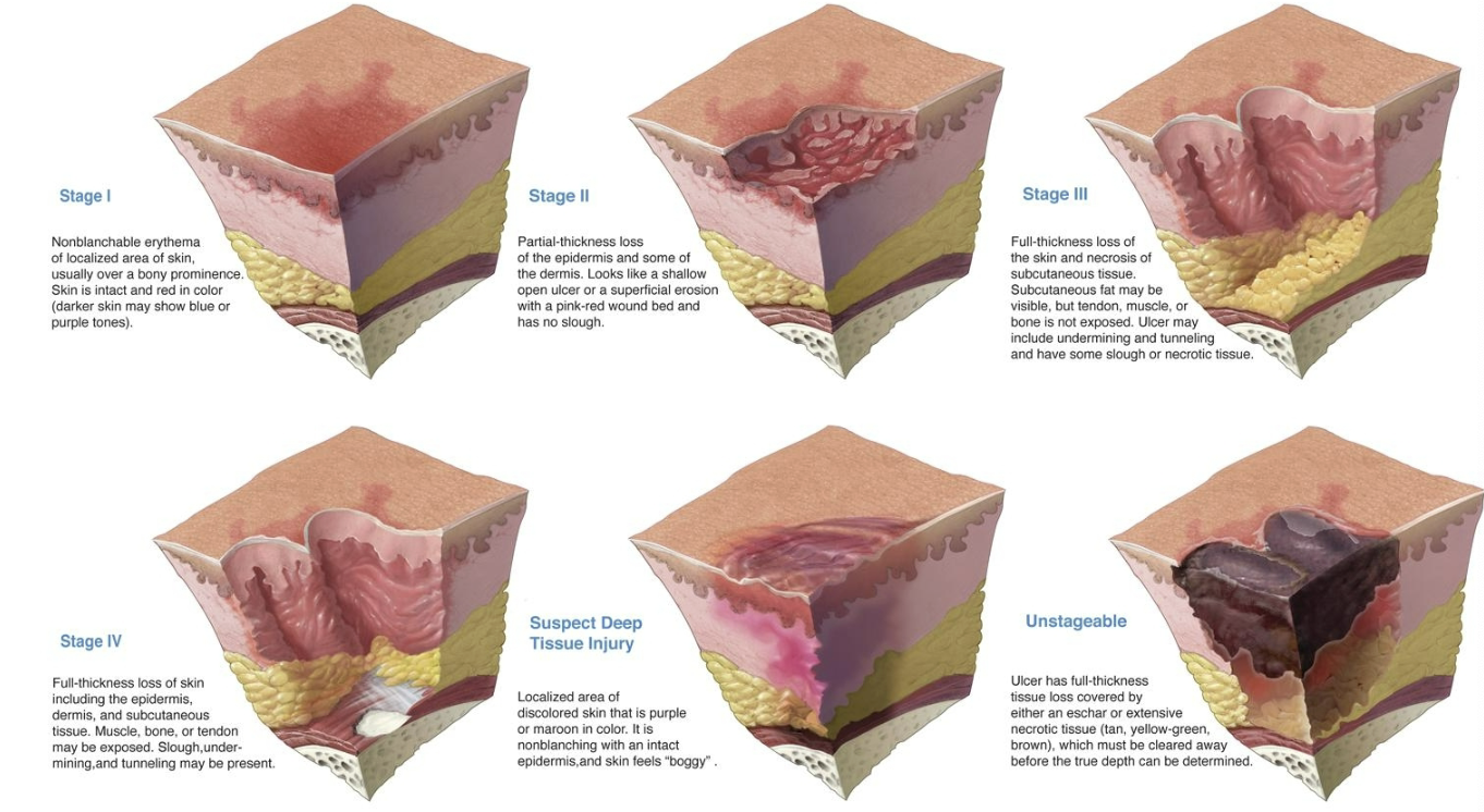 <p>aka pressure injury, pressure sore, decubitus ulcer, bedsore, skin breakdown</p><ul><li><p>can be life threatening</p></li><li><p>can be prevented</p></li><li><p>high risk areas: bony prominences at sacrum, ischium, trochanters, elbows, and heels, iliac crest scapula, knees, toes, occiput, rib cage</p></li></ul><p></p>