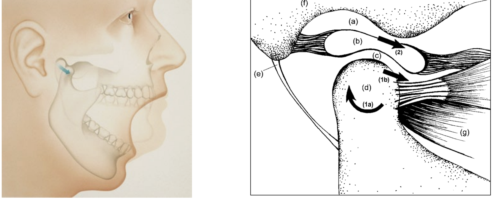 <p>• Initial opening (first ~20–25 mm):Occurs in the lower joint — condylar rotation beneath the disc </p><p>• Further opening (beyond ~25 mm):Involves the upper joint — condyle-disc complex translates forward along the articular eminence</p>