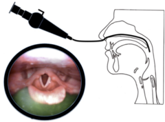 <p>a laryngoscopic technique for viewing swallowing</p>
