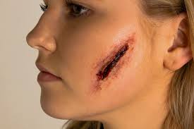 <p>What bandaging technique should be used for this injury?</p>
