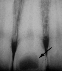 <p>rare, injury to pulpal tissue (trauma)</p>