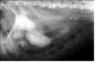 <p>What can be seen in this image and what is the most likely cause based on the fact we have done an excretory urogram </p>