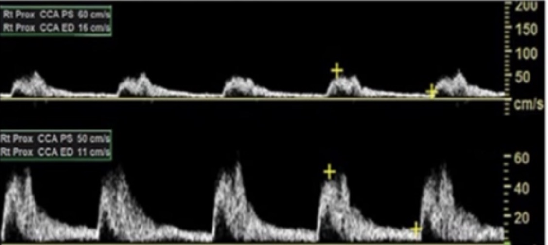 <p>In the first image, the spectral scale is too _______, making the waveform look ______</p>