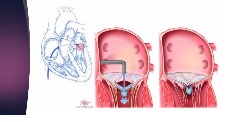 <p>Evaluation of Mitraclip,</p><p>approves for what?</p><p>converts the MV in to a what MV by clipping the what leaflets</p><p>what is it the apparence on echo</p>
