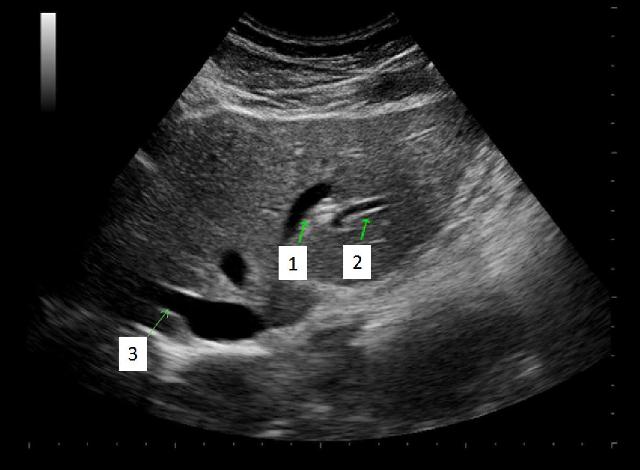 <p>Which of the numbered vessels is part of the portal system?</p>
