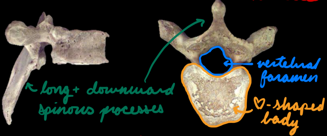 <p>T1-T12</p><p>Curvature: Kyphosis (convex posteriorly)</p><p>Vertebrae:</p><ul><li><p>Body: Heart-shaped</p></li><li><p>Spinous processes: Long + downward</p></li></ul><p></p>