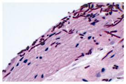 <p>CASE: A 21-year-old with asthma uses an inhaled corticosteroid and develops a wipeable white plaque on the tongue. Which simple biopsy/sampling method discussed in the lecture can help detect the likely process?</p>