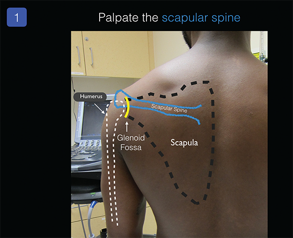 <p><strong>How to Palpate:</strong></p><ul><li><p>Posterior shoulder: prominent ridge running horizontally.</p></li></ul><p></p><p>Confirm: Trace medially to vertebral border; laterally to acromion.</p>