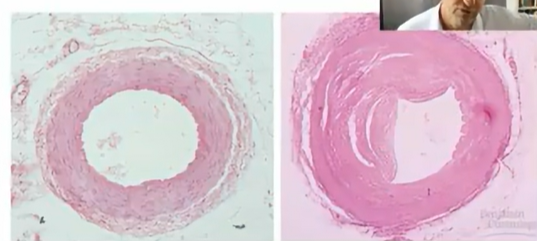 <p>cardiovascular disease</p>