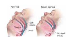 <p>pharyngeal collapse during sleep, which leads to absence of breathing; can produce daytime drowsiness and elevated blood pressure</p><p>causes of this: loud snoring, obesity, large neck, being a male</p>
