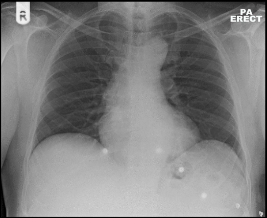 <p><span>Female. 65 years. Acute left sided chest pain. ?MI</span></p>