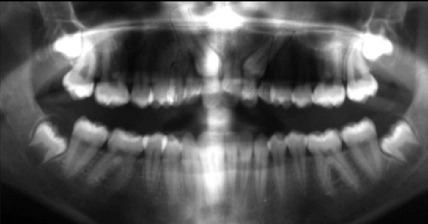 <p>This image shows bilaterally impacted canines. Do you think the patient's right canine is palatally or labially displaced?</p>