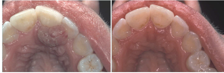 <ul><li><p>conservative surgical excision with removal of any local factors</p></li><li><p>lesions associated with pregnancy may spontaneously regress postpartum</p></li><li><p>recurrences occur due to remaining local factors (calculus) </p></li></ul><p></p>