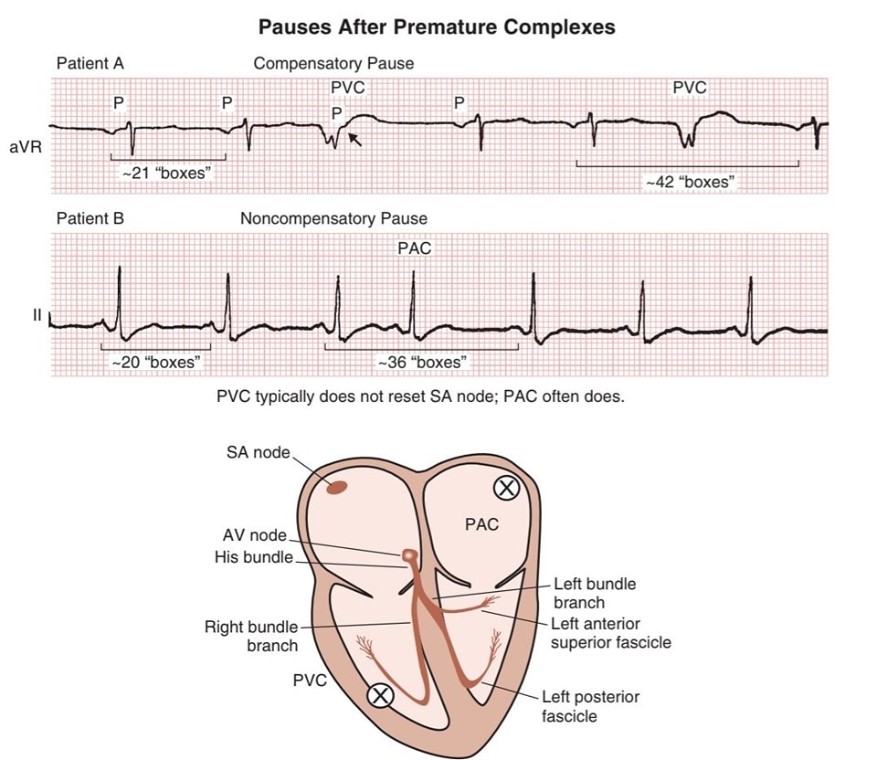 <p>brief pauses that result after a premature/extra beat depolarizes the SA node = SA node resets with a longer than normal interval before the next sinus beat arrives</p>