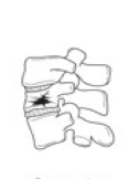 <p>Compression Fracture</p>
