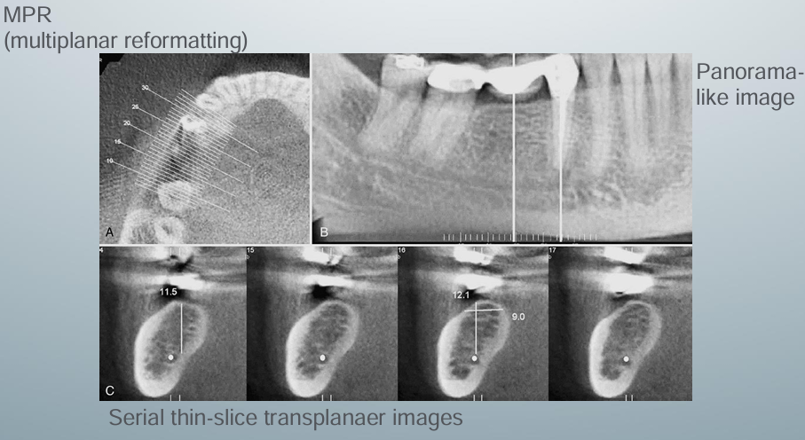 <p>-curved planar MPR (multiplanar reformatting) accomplished by aligning the long axis of the imaging plane with the dental arch in A</p><p>-provides a region panorama-like thin-slice image in B</p><p>-serial thin-slice transplanar images are often generated (C), which are useful in the assessment of specific morphologic features such as the location of the inferior alveolar canal for implant site assessment and for allowing measurement of the available alveolar bone height and width</p>